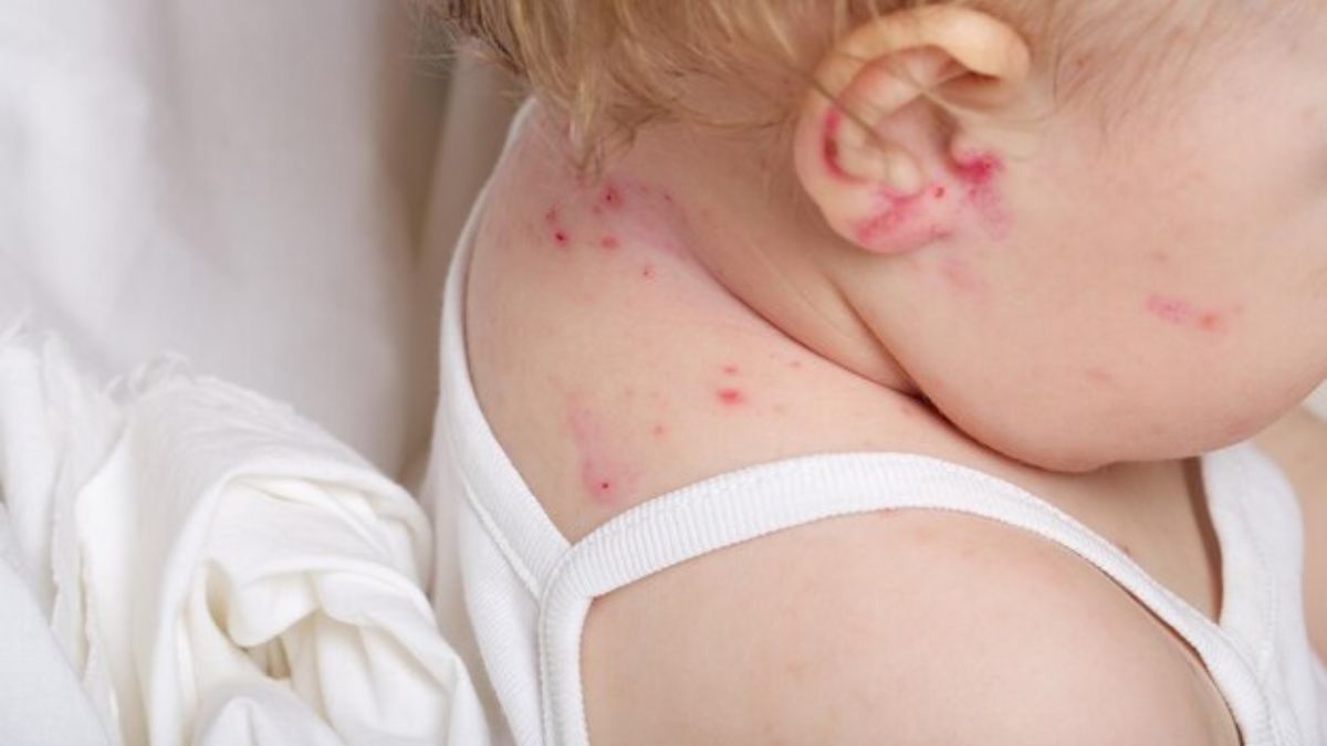 Baby Neck Rash Prevention: மழைக்காலத்தில் குழந்தையின் கழுத்தில் ஏற்படும் சொறியிலிருந்து பாதுகாக்க இத செய்யுங்க