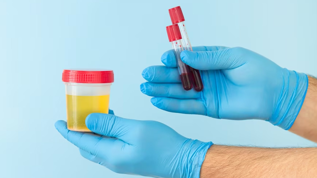 Blood Clots In Urine: Expert Lists Its Causes, Complications, And The Danger Signs